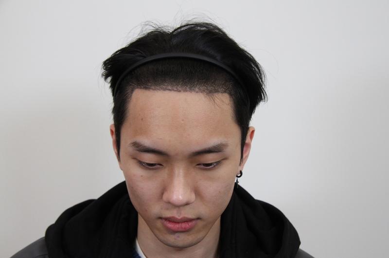 맘모스에서 모발이식하고 2주 됐습니다. 단정해보이네요ㅋ
