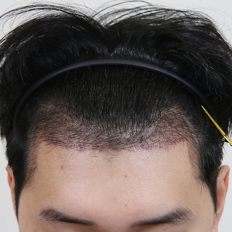 수술 2주 2_전병옥님.jpg