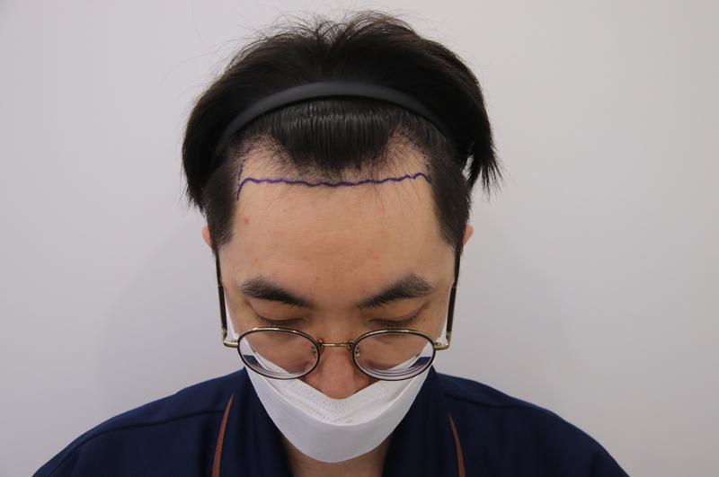 手術5か月経過。 マンモスで良かった点···