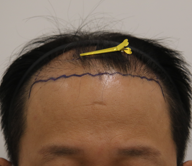 Hair transplant surgery and stem cell combination therapy, Mammoth Busan branch