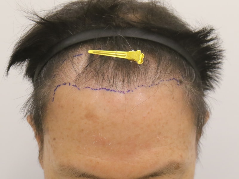 60대에 용기 내어 두번째 수술한지 1년되었습니다