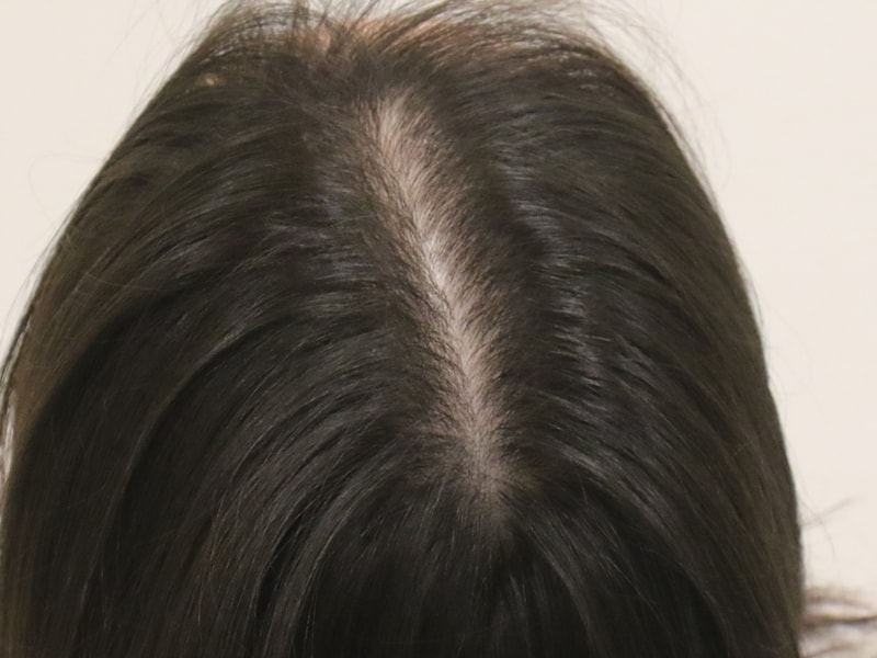 정수리 탈모로 부산 맘모스헤어라인에서 치료와 수술 받았습니다(8개월 경과)