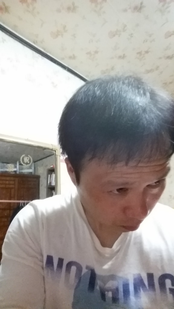 모발이식수술.JPG