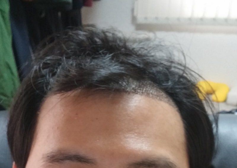 이식후 붕대제거 머리올림2.jpg