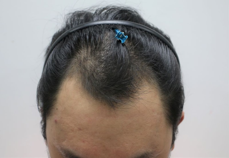 大邱For Hair院长张成浩（音译）的EMZA非切开部分削发3周后记