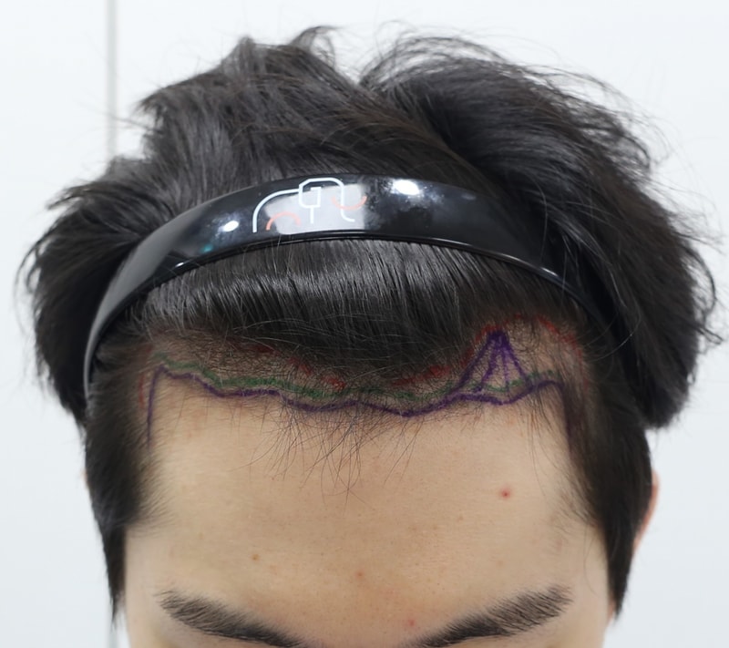 Apgujeong Mammoth Hair Restoration Center's 7th month review of non-intersected hair transplantation!