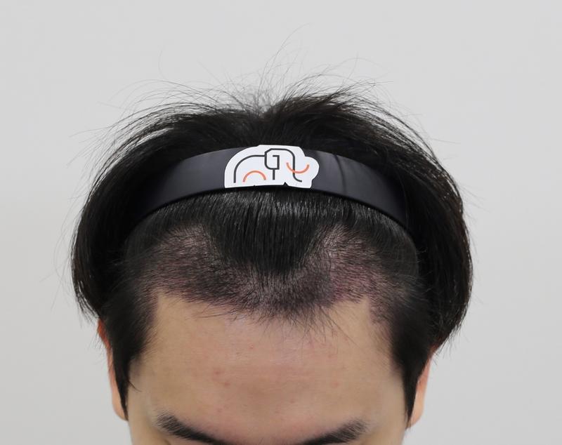 Apgujeong Mammoth Hairline Clinic M-shaped non-cut hair transplant 2nd week