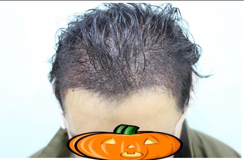 수술직후-앞.jpg