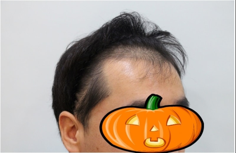 수술전-옆.jpg
