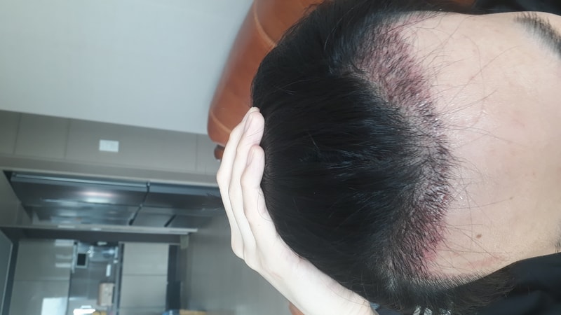 2주경과 딱지제거 지문샴푸 직후 사진 공유합니다.. 평가 좀 부탁드립니다.
