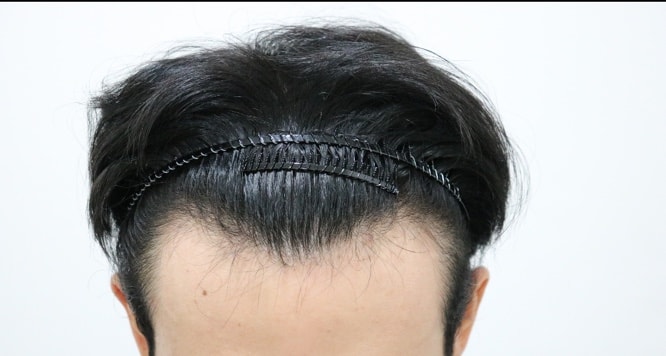 M자, 측면라인 이식수술 받았습니다.어떤가요?