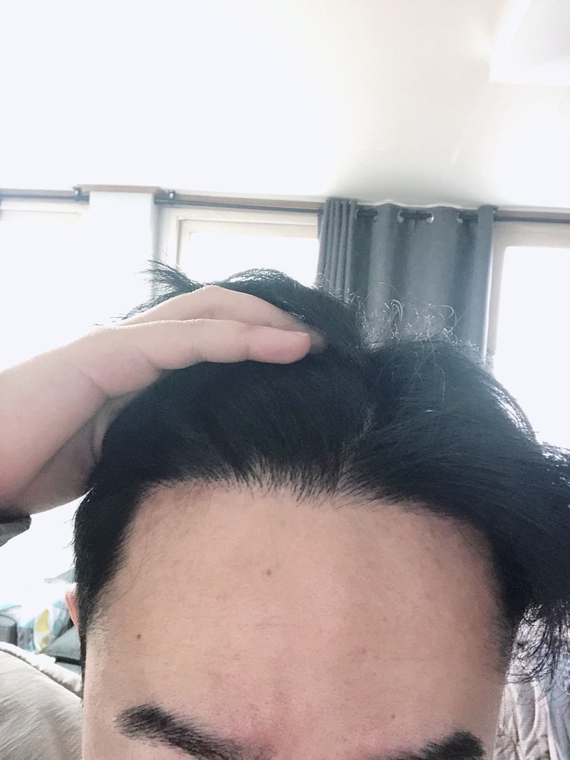 Mo Jae-sung Hospital's 3,200-mo 1,600 hair follicle surgery 1st year and 8 months later, so I put it in properly