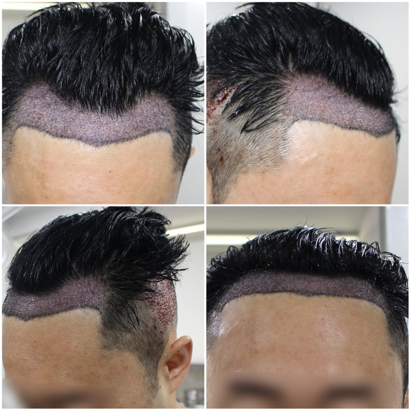수술 직 후.jpg