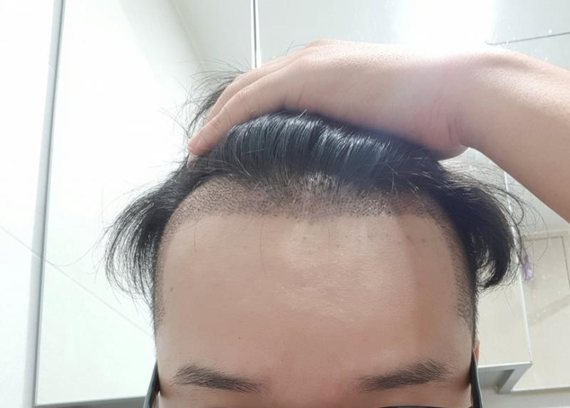 It's the 3rd day of 2800 hair incision
