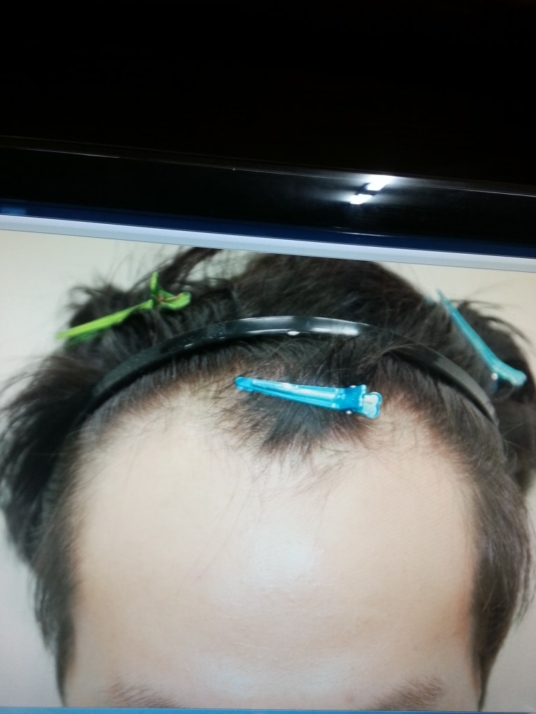 It's the 8th month of hair transplantation.