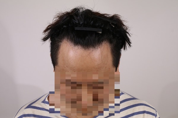 수술전.jpg