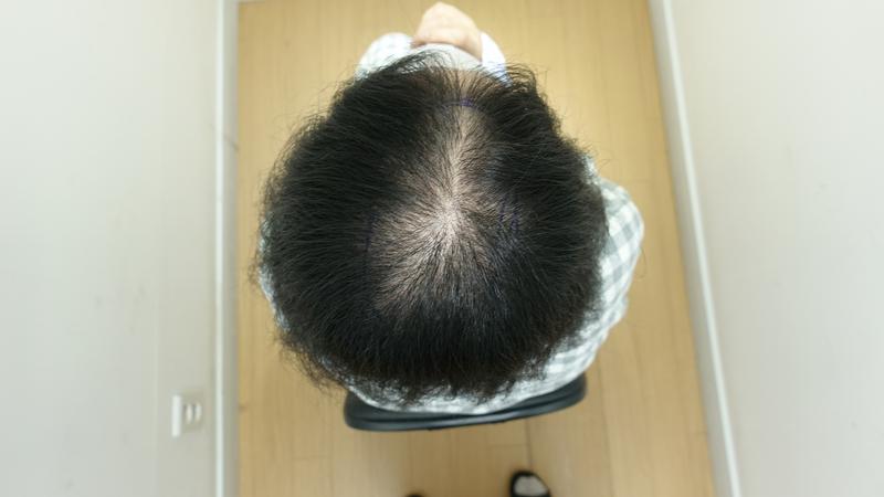 ザラダ病院 頭頂部毛髪移植1年目