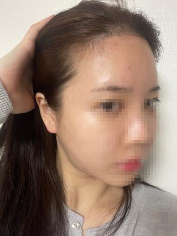 모모성형외과의원비절개모발이식2370모30일경과후기