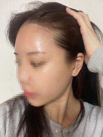 모모성형외과의원비절개모발이식2370모30일경과후기