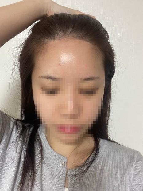 모모성형외과의원 비절개 모발이식 2370모 365일 경과 후기
