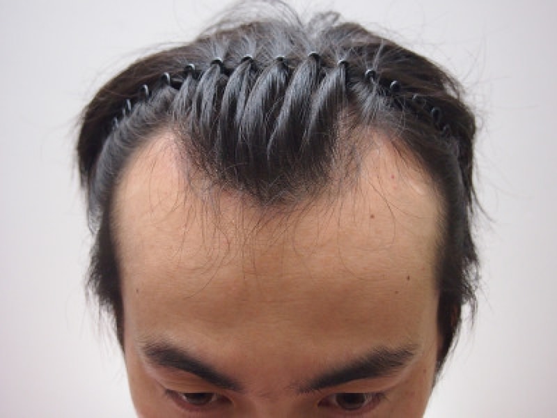 53 days of non-cut hair transplantation for hair