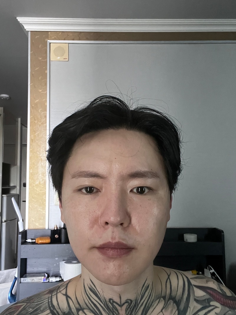 New Hair Seoul branch incision hair transplant 2000 hair follicles 10 months later