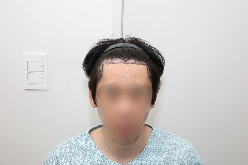 New Hair 首尔店非切开毛发移植 1300 毛囊 第7天后期