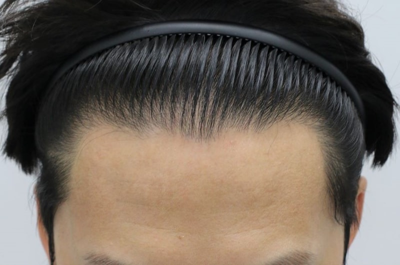 Dissatisfaction with density in other hospitals, 4 months after reoperation of Daegu forehair