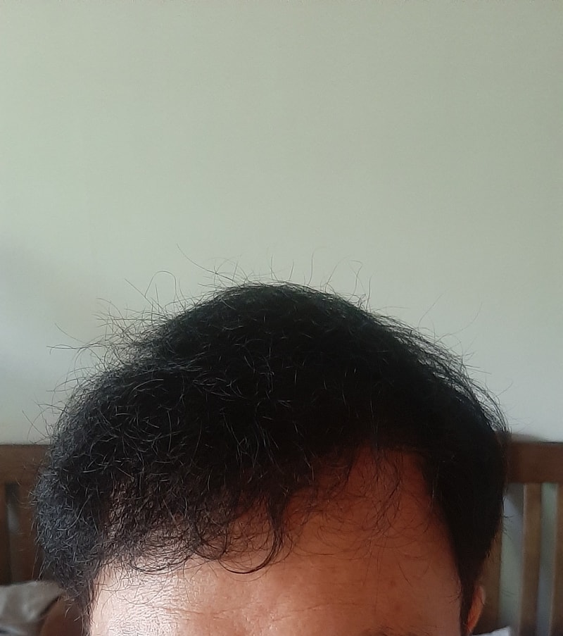 4,500 8 months after follicle surgery. I feel the power of surgery.