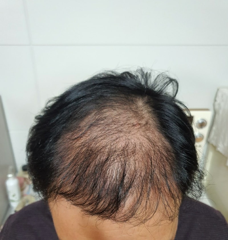 4,500 hair follicles including beard Dana plastic surgery 4 months after hair transplantation