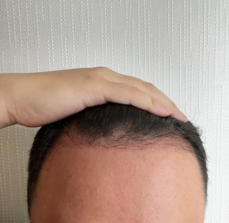 Dana 2-4个月只比较正面