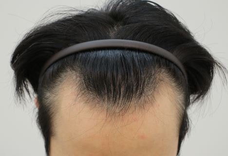 [크기변환]수술전.JPG