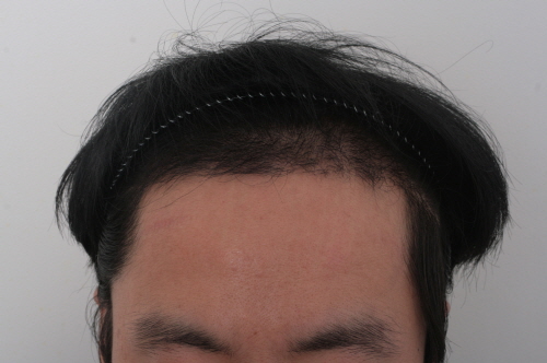3개월경과.jpg