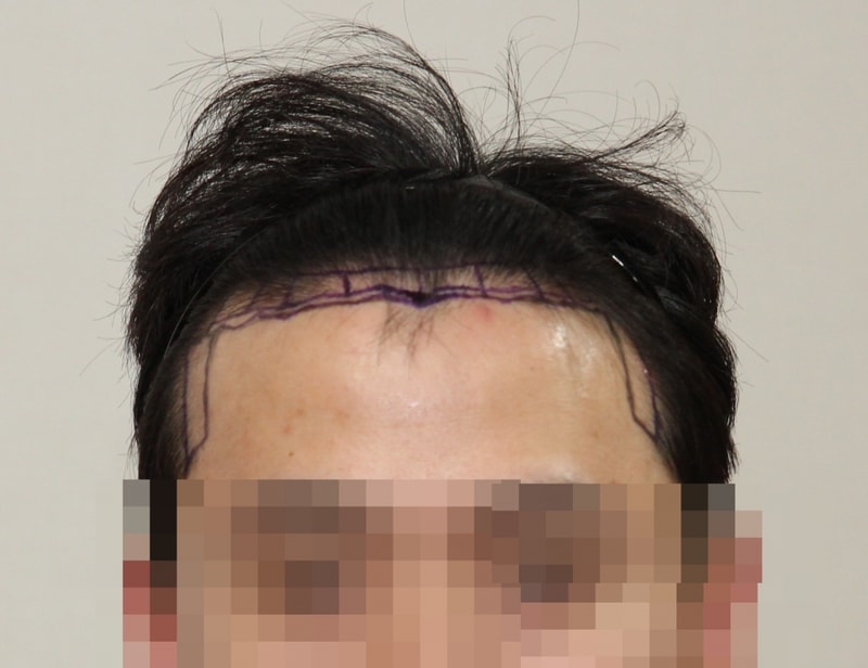 下面是手术6个月后的后记。