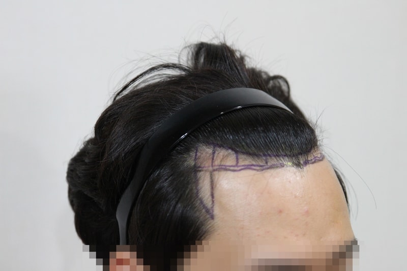 수술 전 모자이크 3.JPG