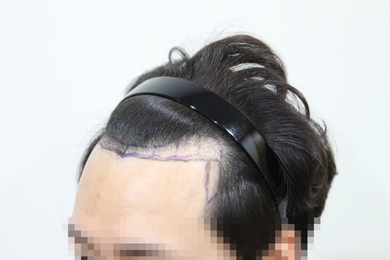 수술 전 모자이크 2.JPG