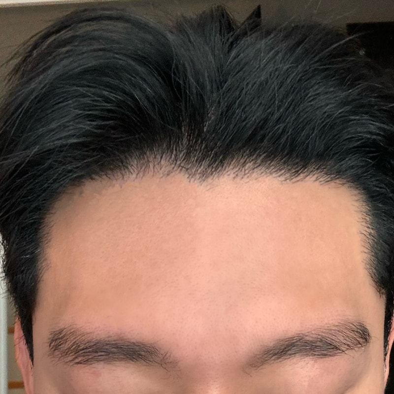 [New Hair] 首尔店 非接缝 毛发移植 1549 毛囊 8个月 后记!!