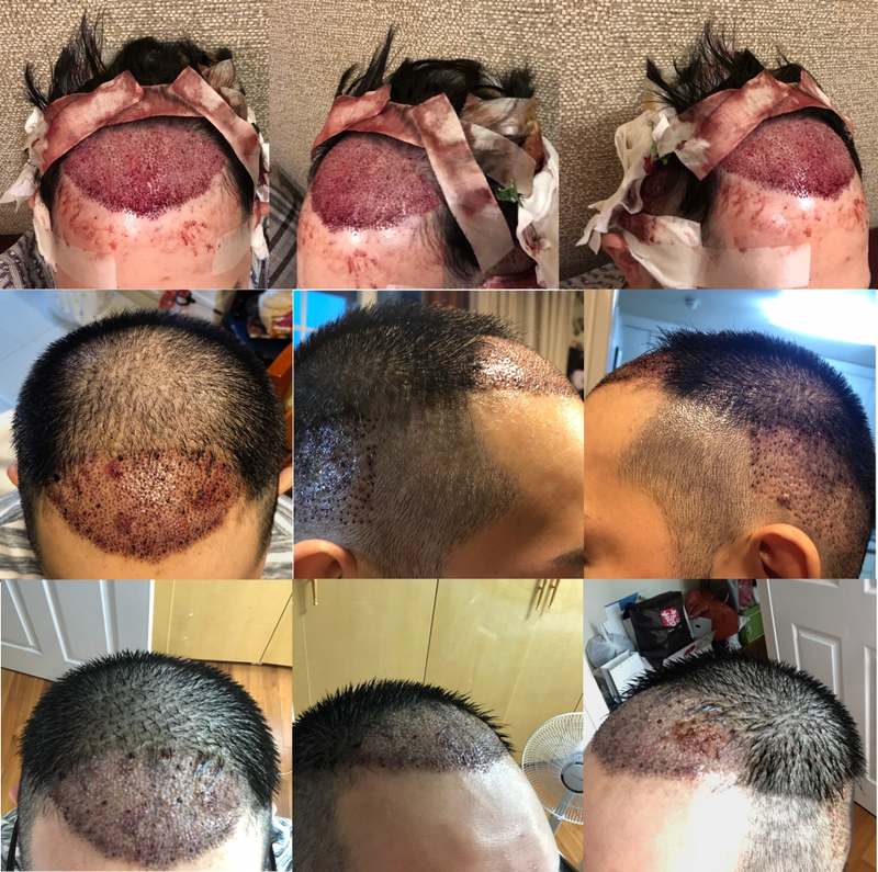Right after NHI New Hair / Day 3 / Day 5 review