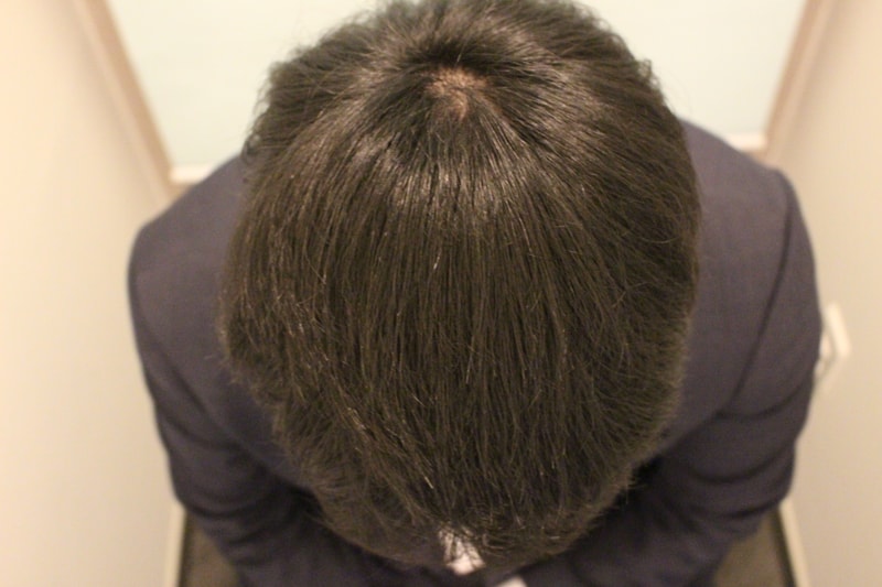 수술후 6개월 2.jpg
