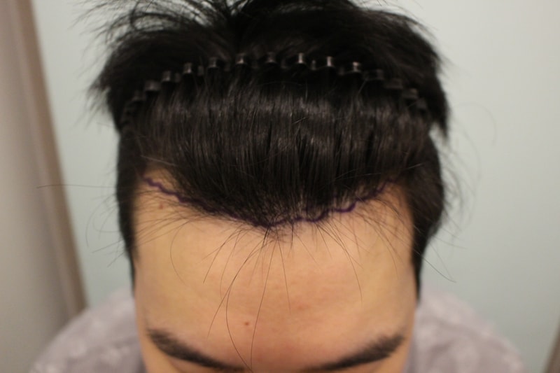 수술전 디자인.jpg