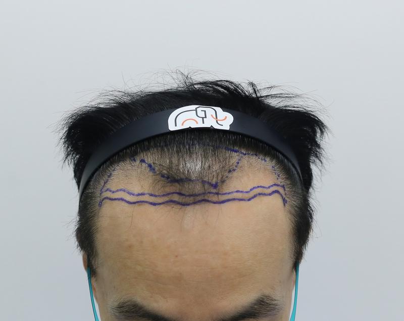 Apgujeong Mamos Hairline Clinic M-shaped Hair Transplantation in 10th Months