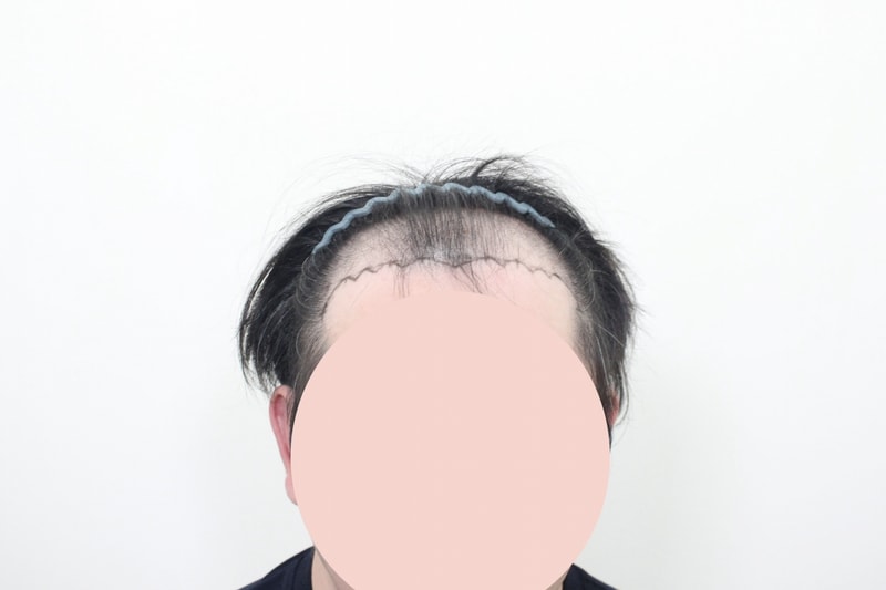 모프로의원 전두부 모발이식 6000모 10일 차