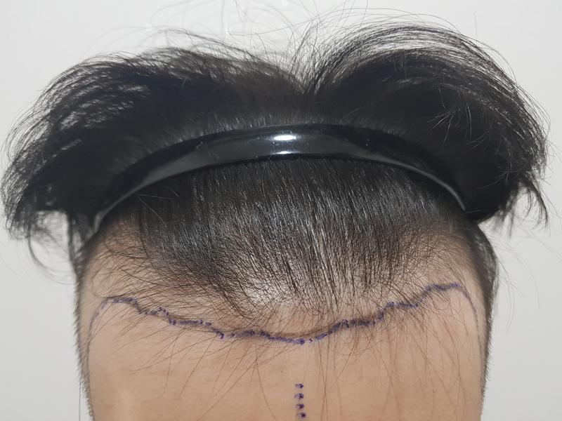 Non-cut 2700 Mo 15 months later half-length