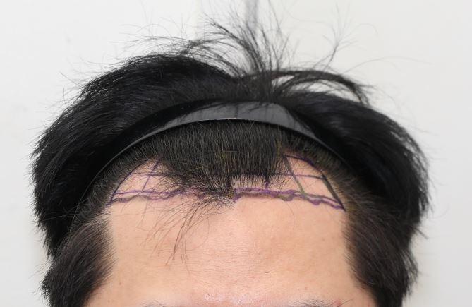 ニューヘア医院のキム·ジンオ院長の毛髪移植1500毛包(切開)1日目のレビュー