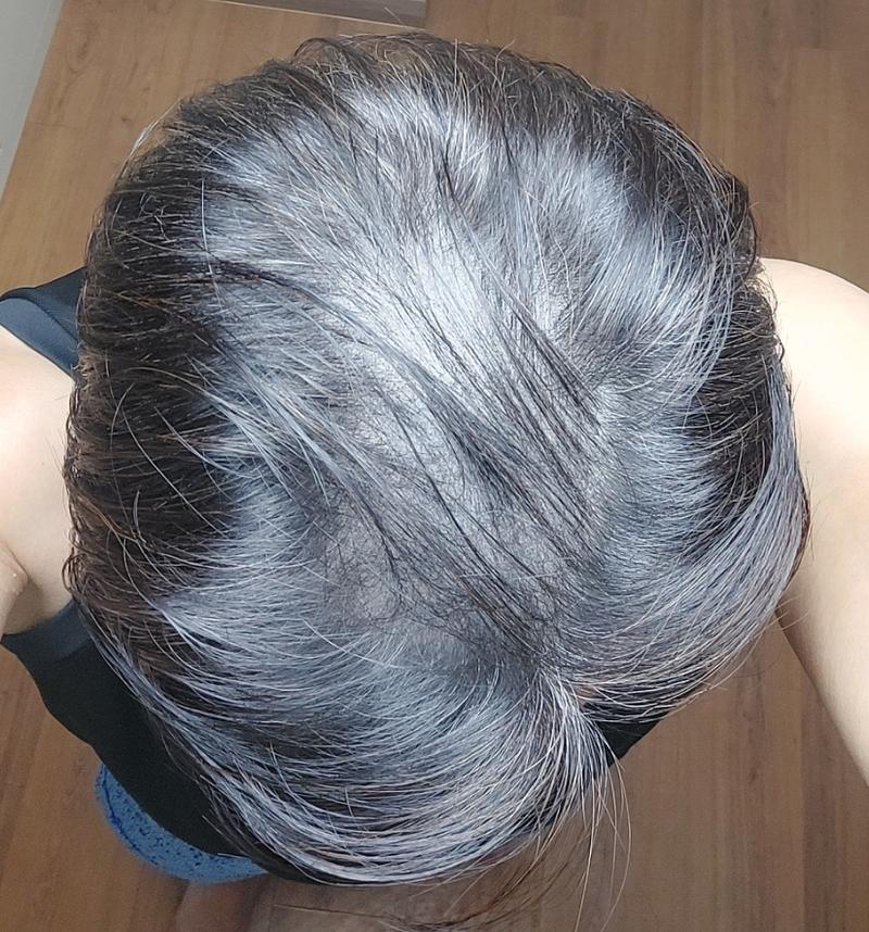 모발이식 포토후기