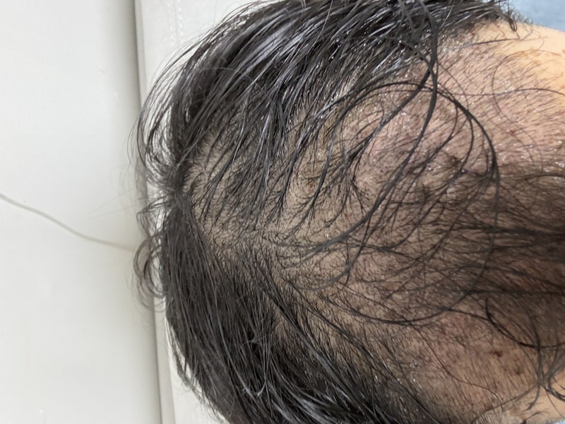 Apgujeong Mo Woo-rim's surgery review