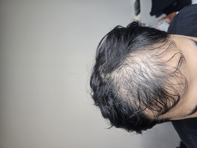 압구정 모우림 의원 수술 후기