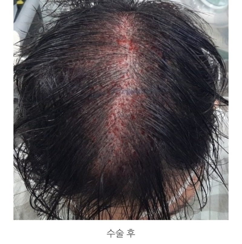 비절개 정수리 4000모 186일 경과