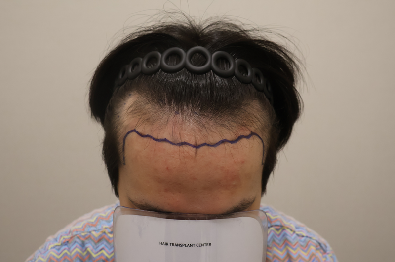 ドンタンヘアで医院切開 毛髪移植 4200毛 手術直後