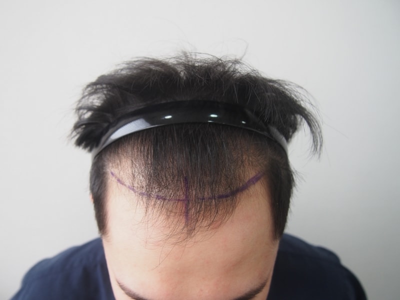 Post-mortem post-mortem 1097 follicle surgery